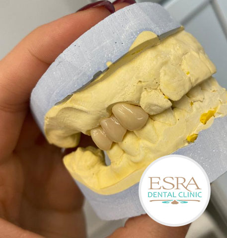 Coroana dentara provizorie Esra Dental Clinic Constanta
